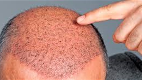 زراعة الشعر