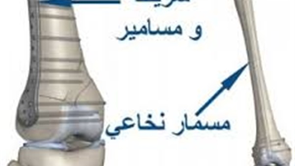 أهمية المسمار النخاعي