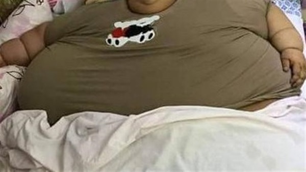  مرض السمنة المفرطة