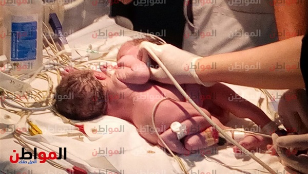 التوأم الملتصق