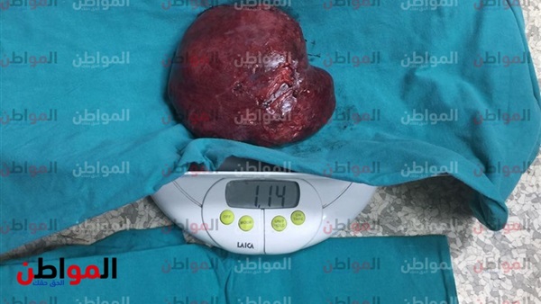 ورم الطفلة جومانه