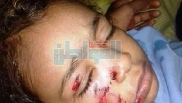 احد الاطفال المصابين