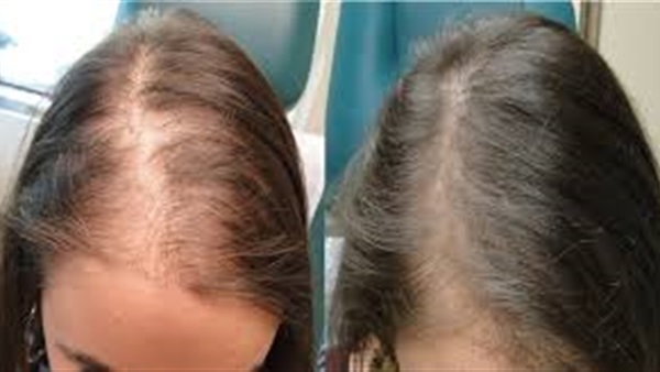 أسس زراعة الشعر